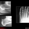 calcifications d'hydroxyapatite aux pieds